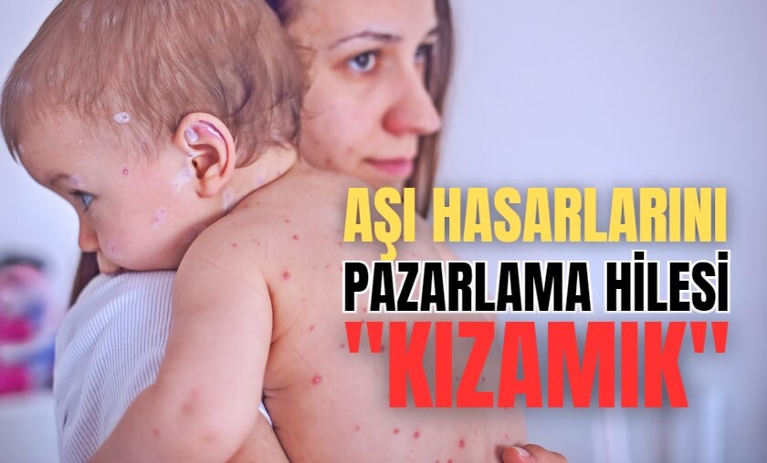 Kızamık Vaka Uydurmaları ve Aşı Hasarlarını Kızamık Olarak Pazarlama Hilekarlığı - YORUMCALAR